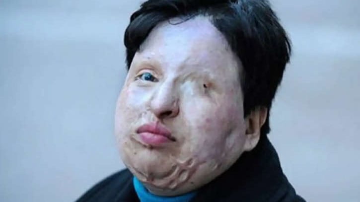 Vítima foi atacada com ácido.