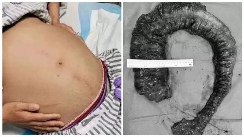 Fezes gigante é retirada de mulher na China; confira