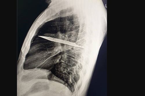 Faca no peito por 8 anos: o achado médico chocante que desafia a medicina